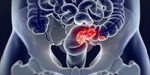 Rectal Cancer Tumor Board